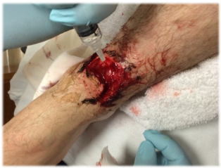 Close up of cut on ankle